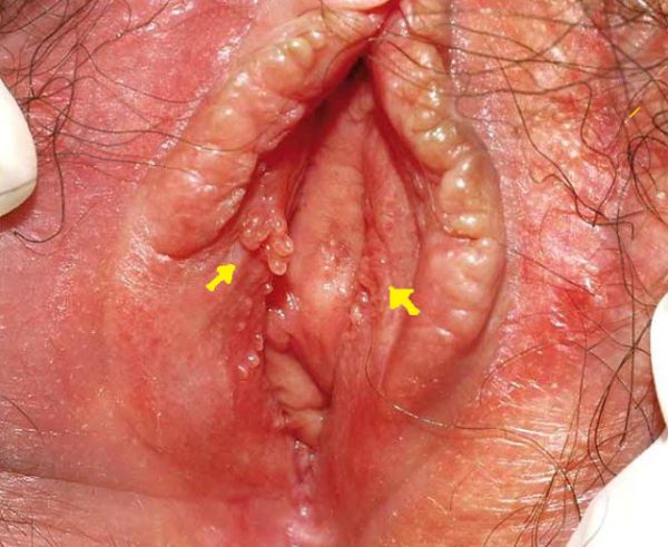 two white ovals in vagina