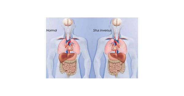 pocus for situs inversus