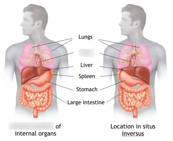 dextrocardia anatomy