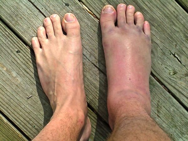 inner ball of foot pain