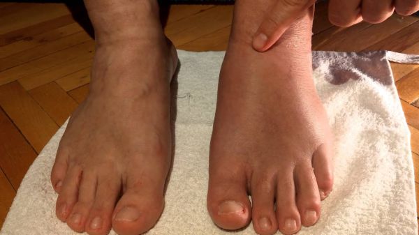 swollen ankles causes and symptoms